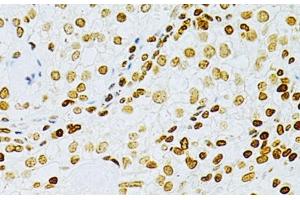 Immunohistochemistry of paraffin-embedded Human cancer using DKC1 Polyclonal Antibody at dilution of 1:200 (40x lens). (DKC1 抗体)