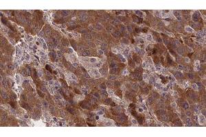 ABIN6277371 at 1/100 staining Human liver cancer tissue by IHC-P. (GRPR 抗体  (Internal Region))