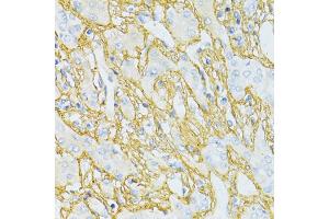 Immunohistochemistry of paraffin-embedded human liver cancer using TGFBI antibody (ABIN5971386) at dilution of 1/100 (40x lens). (TGFBI 抗体)
