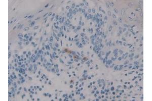 Detection of HIF1aN in Human Skin cancer Tissue using Polyclonal Antibody to Hypoxia Inducible Factor 1 Alpha Subunit Inhibitor (HIF1aN)