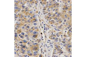 Immunohistochemistry of paraffin-embedded human liver cancer using VAPB Antibody (ABIN5973099) at dilution of 1/200 (40x lens). (VAPB 抗体)