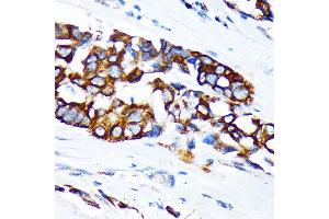 Immunohistochemistry of paraffin-embedded human lung cancer using KRT36 Rabbit pAb (ABIN6130229, ABIN6143029, ABIN6143030 and ABIN6217868) at dilution of 1:100 (40x lens). (Keratin 36 抗体  (AA 388-467))