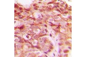 Immunohistochemical analysis of DNAJB4 staining in human breast cancer formalin fixed paraffin embedded tissue section. (DNAJB4 抗体)