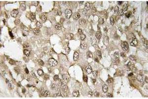 Immunohistochemistry (IHC) analyzes of p-NFkappaB-p65 antibody in paraffin-embedded human breast carcinoma tissue. (NF-kB p65 抗体  (pSer529))