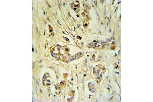 FIBB Antibody (C-term) (ABIN390414 and ABIN2840803) IHC analysis in formalin fixed and paraffin embedded human breast carcinoma followed by peroxidase conjugation of the secondary antibody and DAB staining. (Fibrinogen beta Chain 抗体  (C-Term))