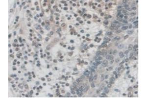 IHC-P analysis of Human Skin Cancer Tissue, with DAB staining. (PALLD 抗体  (AA 1137-1383))