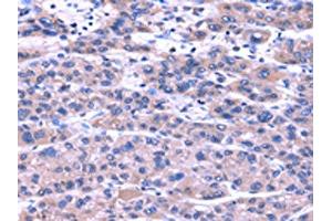 The image on the left is immunohistochemistry of paraffin-embedded Human liver cancer tissue using ABIN7131486(TRIM49 Antibody) at dilution 1/40, on the right is treated with fusion protein. (TRIM49 抗体)