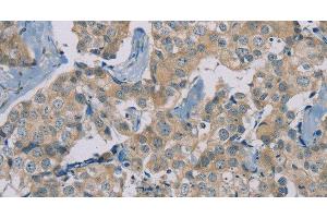 Immunohistochemistry of paraffin-embedded Human breast cancer using RAD51 Polyclonal Antibody at dilution of 1:40 (RAD51 抗体)