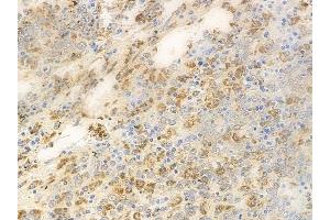 ABIN6264241 and ABIN6269167 at 1/100 staining human melanoma by IHC-P. (PKC alpha 抗体  (C-Term))