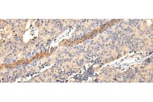 Immunohistochemistry of paraffin-embedded Human prostate cancer using SDCBP Polyclonal Antibody at dilution of 1/40 (SDCBP 抗体)
