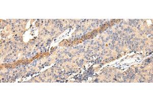 Immunohistochemistry of paraffin-embedded Human prostate cancer using SDCBP Polyclonal Antibody at dilution of 1/40 (SDCBP 抗体)