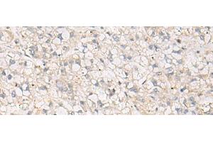 Immunohistochemistry of paraffin-embedded Human liver cancer tissue using TNNT1 Polyclonal Antibody at dilution of 1:35(x200) (TNNT1 抗体)