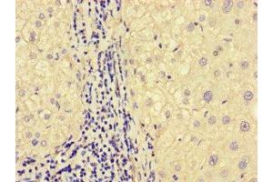 Immunohistochemistry of paraffin-embedded human liver cancer using ABIN7160331 at dilution of 1:100 (FAT Atypical Cadherin 2 (FAT2) (AA 123-314) 抗体)