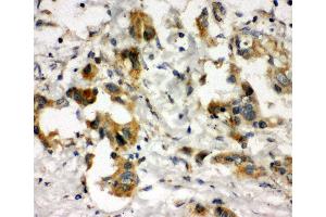 Anti-COMT antibody, IHC(P) IHC(P): Human Lung Cancer Tissue (COMT 抗体  (N-Term))