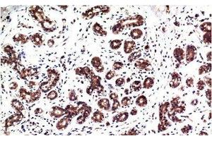 Immunohistochemistry of paraffin-embedded Human breast carcinoma tissue with Phospho-ERK 1/2 (Tyr222/205) Monoclonal Antibody at dilution of 1:200 (ERK1/2 抗体  (pTyr205, pTyr222))