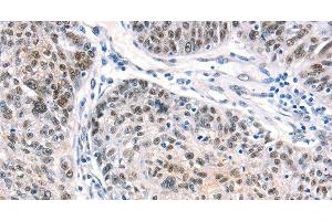 Immunohistochemistry of paraffin-embedded Human ovarian cancer using CTBP2 Polyclonal Antibody at dilution of 1:40 (CTBP2 抗体)