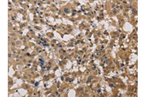 The image on the left is immunohistochemistry of paraffin-embedded Human thyroid cancer tissue using ABIN7129190(DEGS1 Antibody) at dilution 1/40, on the right is treated with fusion protein. (DEGS1 抗体)