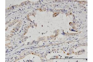 Immunoperoxidase of purified MaxPab antibody to IMPA2 on formalin-fixed paraffin-embedded human colon cancer. (IMPA2 抗体  (AA 1-288))