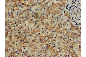 Immunohistochemistry of paraffin-embedded human liver cancer using ABIN7148969 at dilution of 1:100 (CTH 抗体  (AA 1-70))