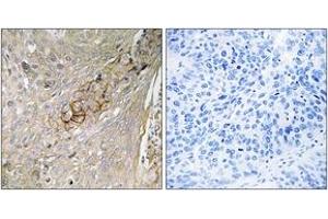 Immunohistochemistry analysis of paraffin-embedded human lung carcinoma tissue, using SLC6A6 Antibody. (TAUT 抗体  (AA 561-610))