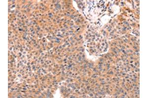 The image on the left is immunohistochemistry of paraffin-embedded Human liver cancer tissue using ABIN7129152(DAZ4 Antibody) at dilution 1/50, on the right is treated with fusion protein. (DAZ4 抗体)