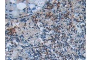 Detection of CC16 in Human Lung cancer Tissue using Polyclonal Antibody to Clara Cell Protein 16 (CC16) (SCGB1A1 抗体  (AA 23-91))