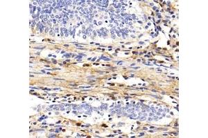 Immunohistochemistry analysis of paraffin-embedded human colon cancer using MFAP4 (ABIN7074614) at dilution of 1: 2000 (MFAP4 抗体)
