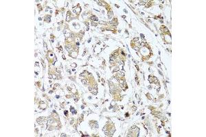 Immunohistochemistry of paraffin-embedded human gastric cancer using CPA1 antibody. (CPA1 抗体)