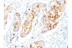 Formalin-fixed, paraffin-embedded human Lung SCC stained with Cytokeratin 7/17 Mouse Monoclonal Antibody (C-46). (Keratin 7/17 抗体)