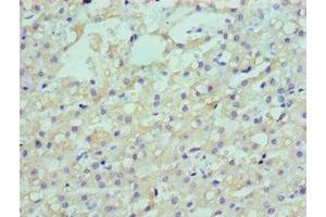 Immunohistochemistry of paraffin-embedded human liver cancer using ABIN7158555 at dilution of 1:100
