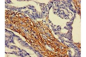 Immunohistochemistry of paraffin-embedded human colon cancer using ABIN7144568 at dilution of 1:100 (ARAP3 抗体  (AA 163-320))