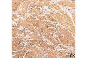 IHC staining of human leiomyosarcoma (10X) with Muscle actin antibody (HHF35). (Actin 抗体)
