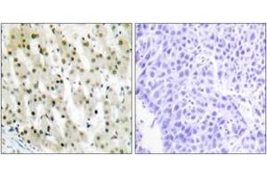 Immunohistochemistry analysis of paraffin-embedded human liver carcinoma tissue, using hnRNP A1 Antibody. (HNRNPA1 抗体  (AA 51-100))