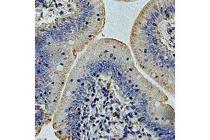 Immunohistochemical analysis of GP73 staining in human colon cancer formalin fixed paraffin embedded tissue section. (GOLM1 抗体)