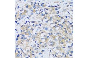 Immunohistochemistry of paraffin-embedded human breast cancer using C antibody (ABIN6129635, ABIN6137807, ABIN6137808 and ABIN6217796) at dilution of 1:100 (40x lens). (CABP7 抗体  (AA 100-180))