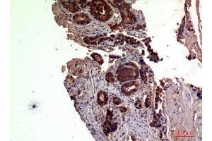 Immunohistochemistry (IHC) analysis of paraffin-embedded Human Prostate Cancer, antibody was diluted at 1:100.