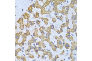 Immunohistochemistry of paraffin-embedded human liver cancer using PRKCD antibody at dilution of 1:100 (40x lens). (PKC delta 抗体)
