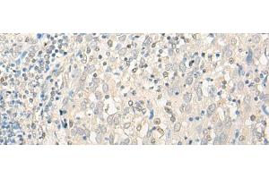 Immunohistochemistry of paraffin-embedded Human cervical cancer tissue using UBXN1 Polyclonal Antibody at dilution of 1:35(x200) (UBXN1 抗体)