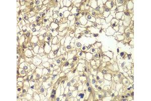 Immunohistochemistry of paraffin-embedded Human kidney cancer using CD1D Polyclonal Antibody at dilution of 1:200 (40x lens). (CD1d 抗体)