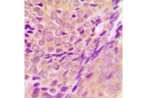 Immunohistochemical analysis of ZADH2 staining in human breast cancer formalin fixed paraffin embedded tissue section. (ZADH2 抗体  (Center))