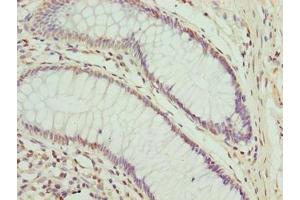 Immunohistochemistry of paraffin-embedded human colon cancer using ABIN7148653 at dilution of 1:100 (CPXCR1 抗体  (AA 1-301))