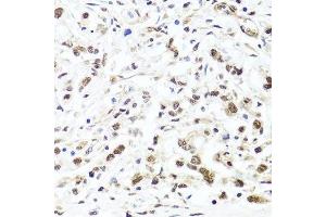 Immunohistochemistry of paraffin-embedded human gastric cancer using HIRA antibody. (HIRA 抗体  (AA 250-550))