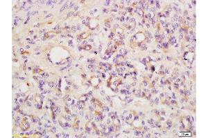 Formalin-fixed and paraffin embedded mouse tumor tissue labeled with Anti ANGPT3/ANG3/ANGPT4/ANG4 Polyclonal Antibody,Unconjugated  at 1:200 followed by conjugation to the secondary antibody and DAB staining. (Angiopoietin 4 抗体  (AA 410-503))