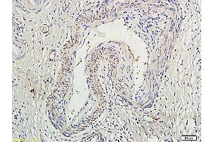 Formalin-fixed and paraffin embedded human colon cancer labeled with Anti-Socs1Polyclonal Antibody (ABIN725135), Unconjugated at 1:300, followed by conjugation to the secondary antibody and DAB staining (SOCS1 抗体  (AA 121-211))