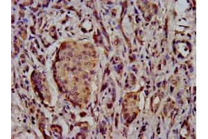IHC image of ABIN7169920 diluted at 1:500 and staining in paraffin-embedded human pancreatic cancer performed on a Leica BondTM system.