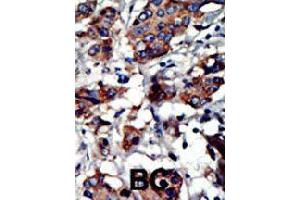 Formalin-fixed and paraffin-embedded human cancer tissue reacted with PACSIN3 polyclonal antibody  , which was peroxidase-conjugated to the secondary antibody, followed by AEC staining. (PACSIN3 抗体  (N-Term))