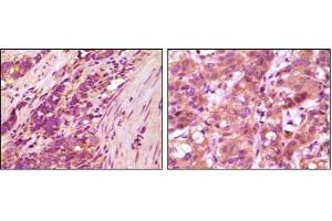 Immunohistochemical analysis of paraffin-embedded human stomach carcinoma (left) and breast carcinoma (right), showing cytoplasmic localization using fibulin5 antibody with DAB staining. (Fibulin 5 抗体)