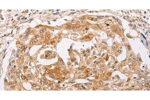 Immunohistochemistry of paraffin-embedded Human cervical cancer using PPP1CB Polyclonal Antibody at dilution of 1:30 (PPP1CB 抗体)