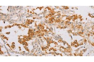 Immunohistochemistry of paraffin-embedded Human thyroid cancer tissue using STK40 Polyclonal Antibody at dilution 1:40 (STK40 抗体)