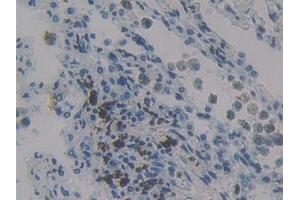 Detection of MCP4 in Human Lung cancer Tissue using Polyclonal Antibody to Monocyte Chemotactic Protein 4 (MCP4) (CCL13 抗体  (AA 24-98))